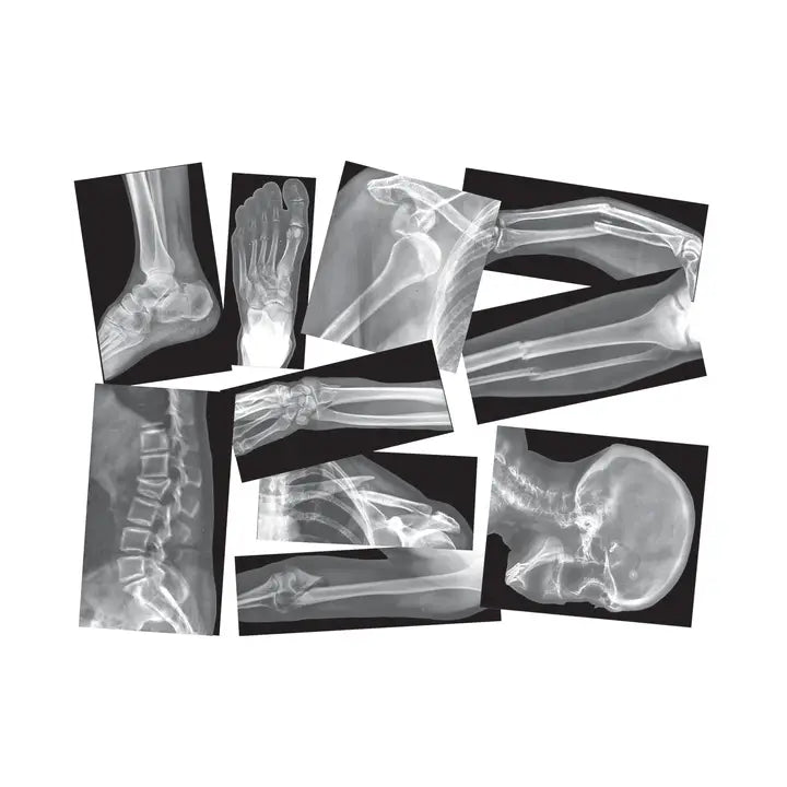 Broken Bones X-Ray - Realistic Stem Learning Supply